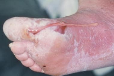 खोला तर्ने क्रममा बेपत्ता भएका गोरखा आरुघाटका सानुकमल गुरुङको दाहिने खुट्टा फेला पर्‍यो